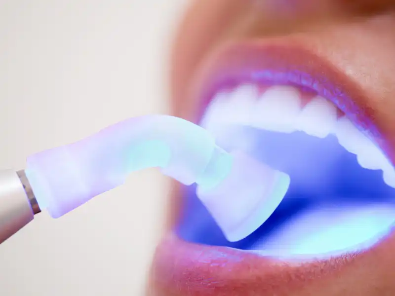 Close-up of a dentist using a blue UV curing light on teeth.
