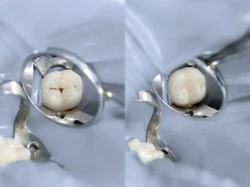 tooth colored fillings lafayette