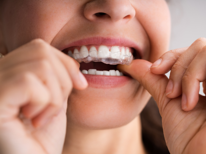 Close-up of a girl inserting a teeth grinding nightguard into her mouth.