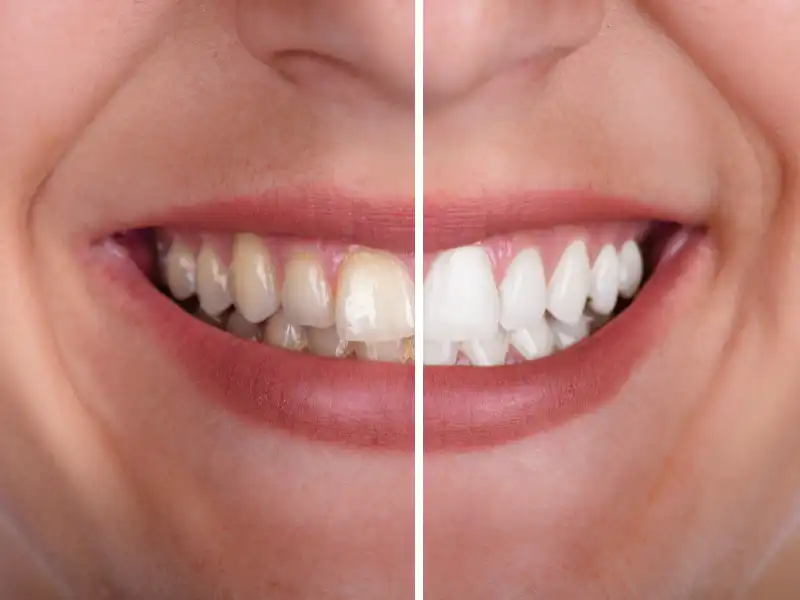 Comparative picture before and after a successful dental service in Broussard, LA.