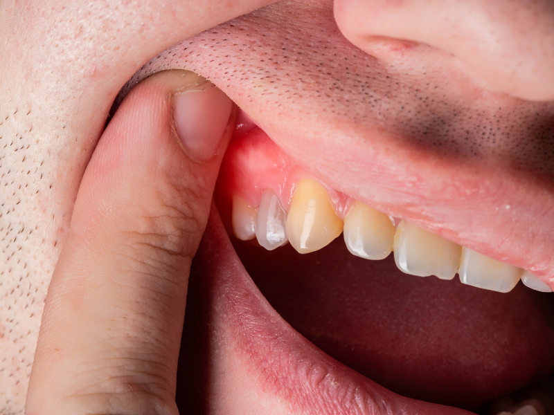 Are Same Day Crowns as Good as Lab Crowns?